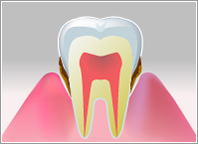 歯周病・イメージ