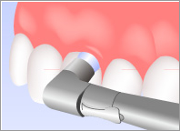 専門家による歯のクリーニングPMTC